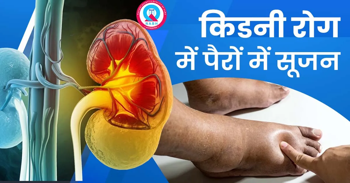 किडनी-रोग-में-पैरों-में-सूजन